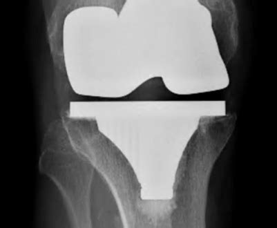 Secondary Patellar Resurfacing as a Rescue Procedure for .